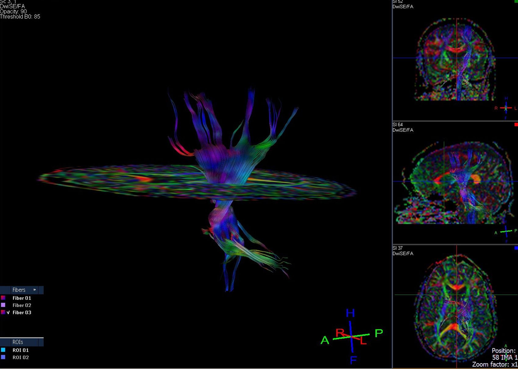 Tractography and DTI image of the brain